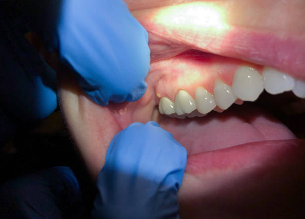 Best Emergency Treatment for Dental Infections or Abscesses in Leesville, LA
