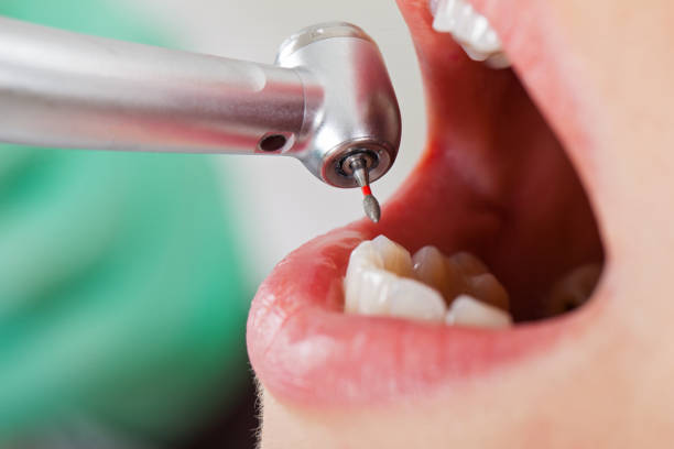 Best Emergency Gum Treatment in Leesville, LA